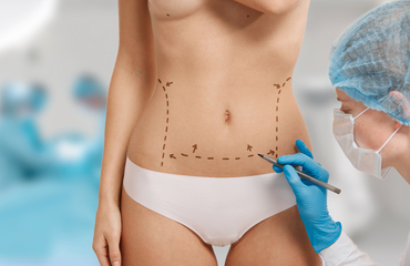 Procédure d'abdominoplastie