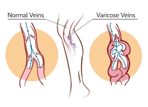 Varicose Veins 101: Causes, Symptoms, and Treatment Options
