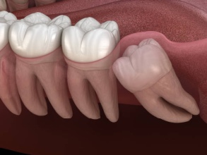 Everything You Need to Know About Wisdom Teeth