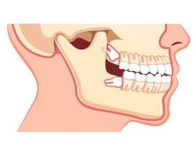 Everything You Need to Know About Wisdom Teeth