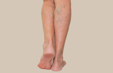 5 Signs You Need Varicose Vein Treatment Now