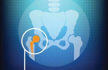 Hip Replacement Surgery: Procedure, Recovery Time & Benefits
