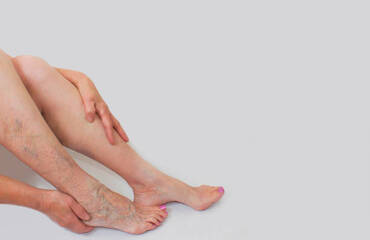What Happens If Varicose Veins Are Left Untreated?