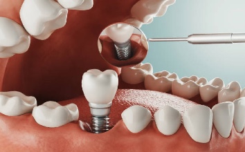 A Simple Guide to Dental Implants 