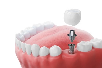 A Simple Guide to Dental Implants 