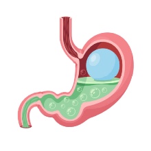  Gastric Balloon: A Non-Surgical Solution for Weight Loss