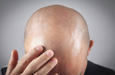 Do Hair Transplants Look Natural? Real Facts vs. Myths