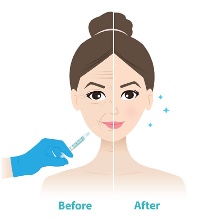 Dermal Fillers: Restore Your Youth