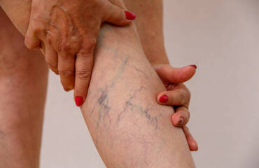 Varicose Veins 101: Causes, Symptoms, and Treatment Options